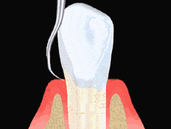 Scaling, Periodontal Therapy animated illustration